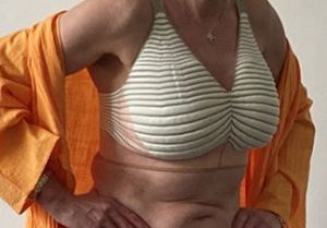 Janssen Huidtherapie nodigt dames met lymfoedeem na borstkanker uit kennis te maken met nieuw hulpmiddel